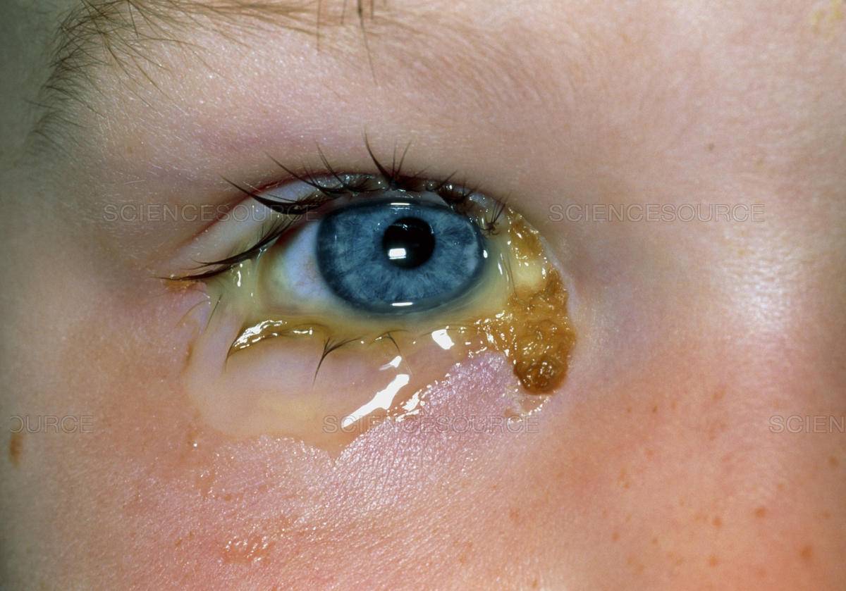Конъюнктивит у ребенка: лечение, причины, симптомы, виды, как выглядит (фото), сколько длиться