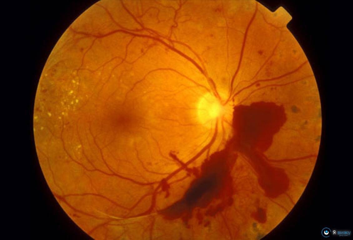 Ретинит — воспаление сетчатки глаза