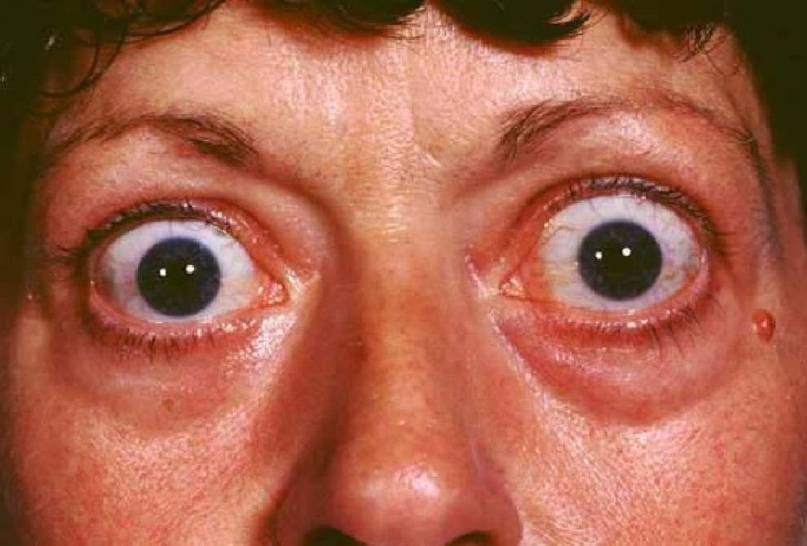 Выпученные глаза при щитовидке и другие глазные симптомы