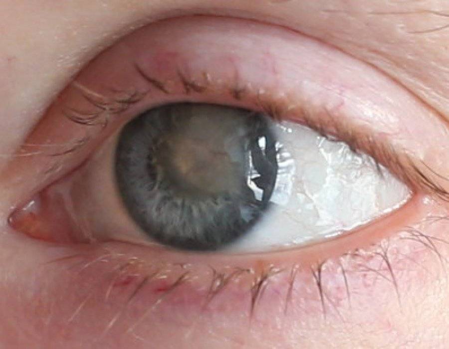 Воспаление роговицы глаза: симптомы и лечение - "здоровое око"