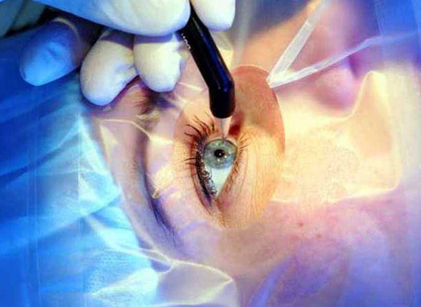 Осложнения после лазерной коррекции зрения - "здоровое око"