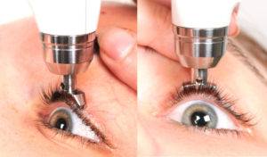 Тонометрия глаза - способы измерения внутриглазного давления