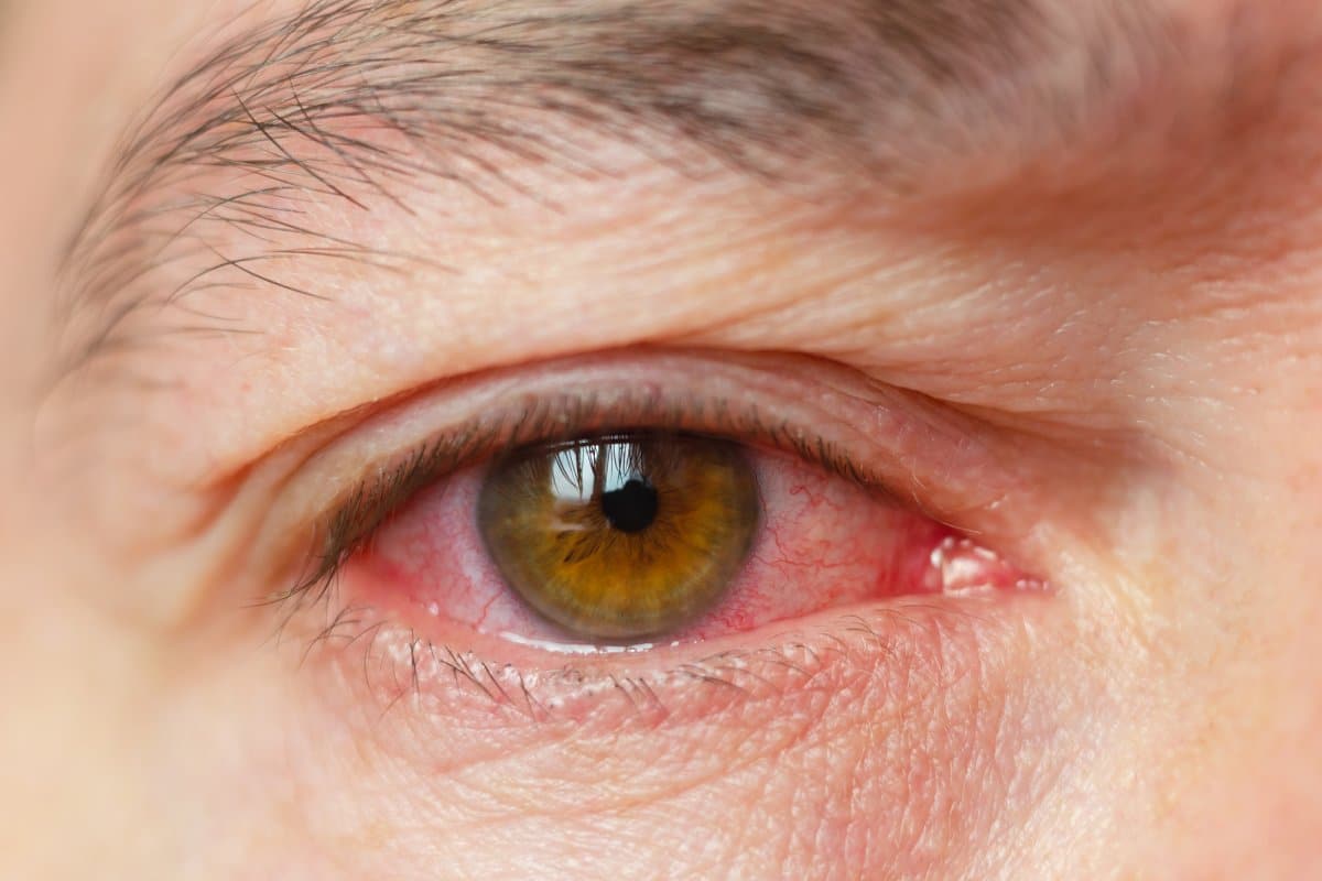 Режет глаза: причины, лечение каплями, что делать, когда присоединяется слезотечение