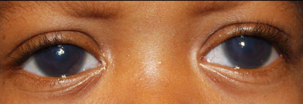 Причины появления и лечение амавроза глаз