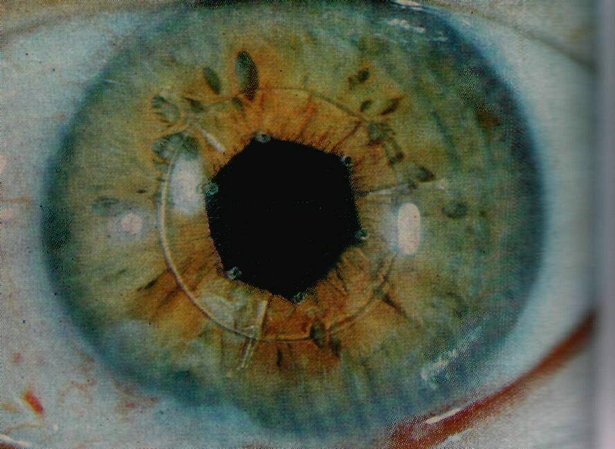 Когда применяется артифакия глаза, возможные осложнения