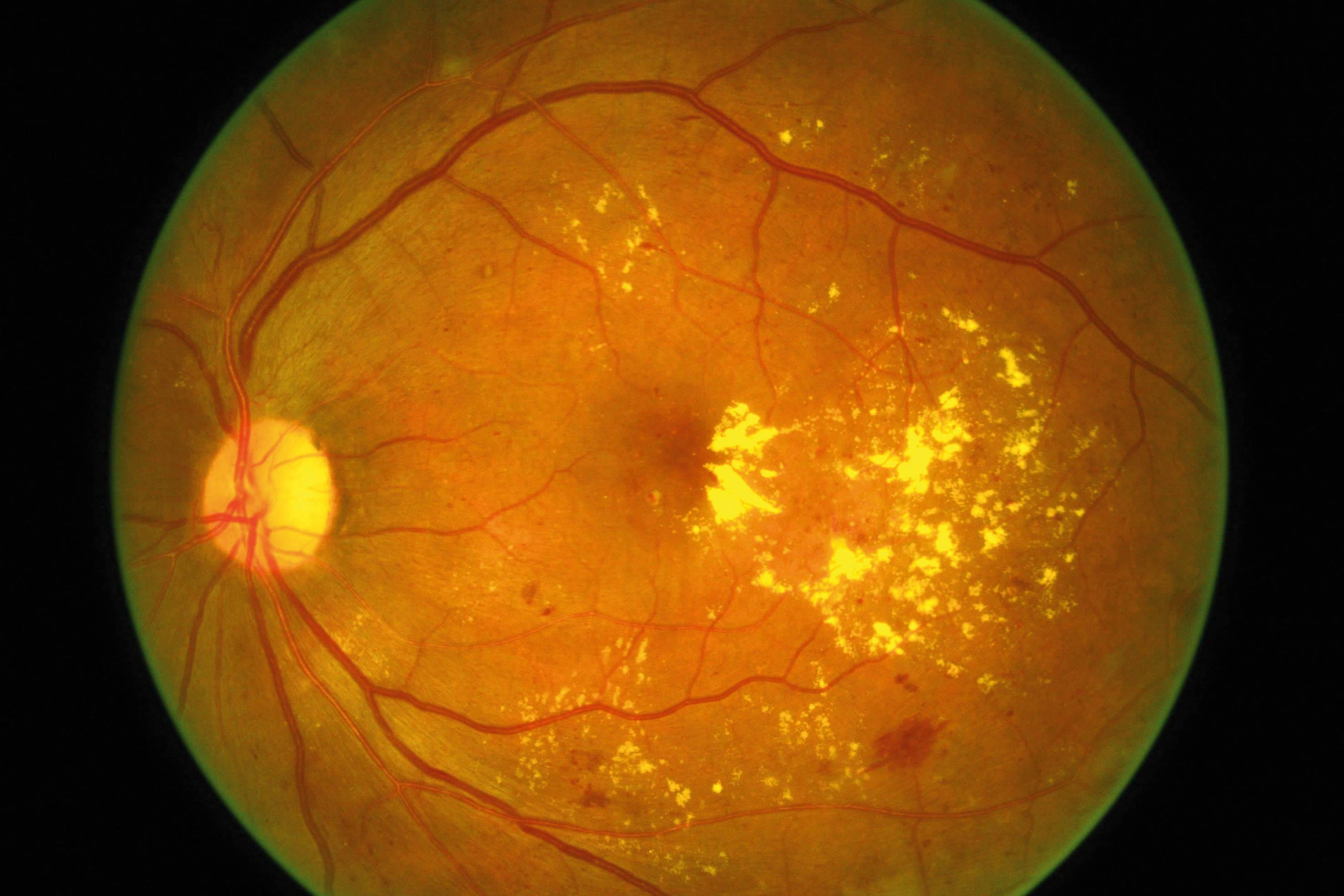 Ангиосклероз сетчатки глаза: симптомы и лечение - "здоровое око"