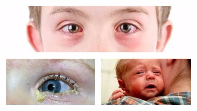 Конъюнктивит у ребёнка в 2 года - особенности лечения oculistic.ru
конъюнктивит у ребёнка в 2 года - особенности лечения
