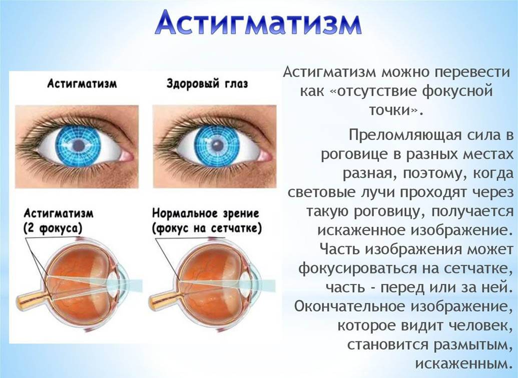 Пресбиопия глаз - что это такое и как лечить у взрослых