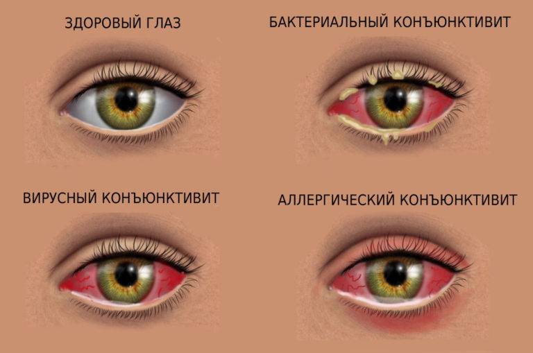 Как передается конъюнктивит, он заразен или нет? - "здоровое око"