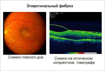 Эпиретинальная мембрана глаза, лечение, код по мкб 10, отзывы об операции