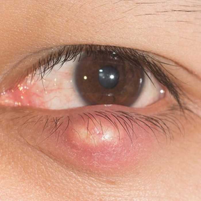 Герпес на глазу (офтальмогерпес) — лечение, симптомы (фото)