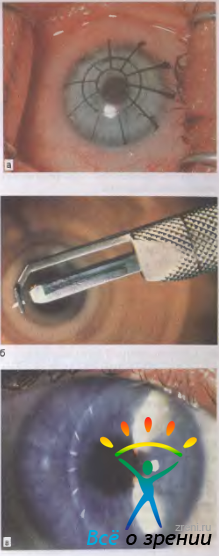 Кератотомия: описание методик радиальной и лазерной операции
