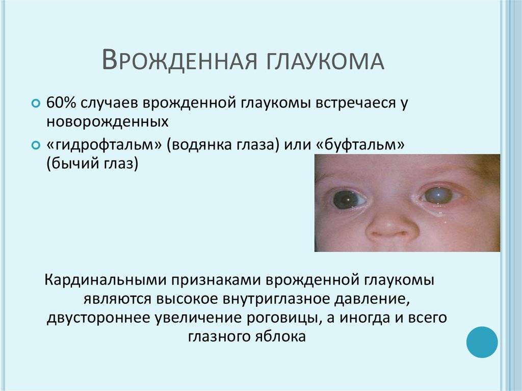 Что такое глаукома у ребенка врожденная - вылечимглаукому