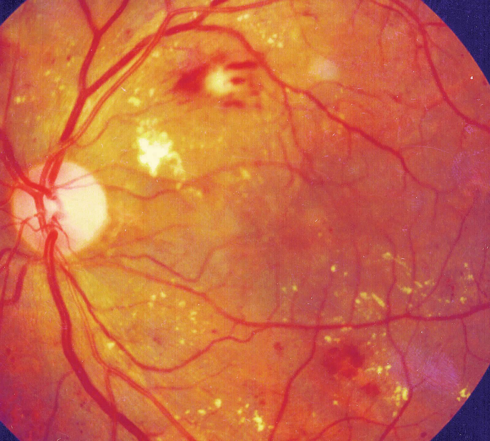 Что такое диабетическая ретинопатия глаз?