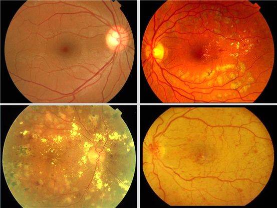 Ювенильный ретиношизис. причины. симптомы. диагностика. лечение