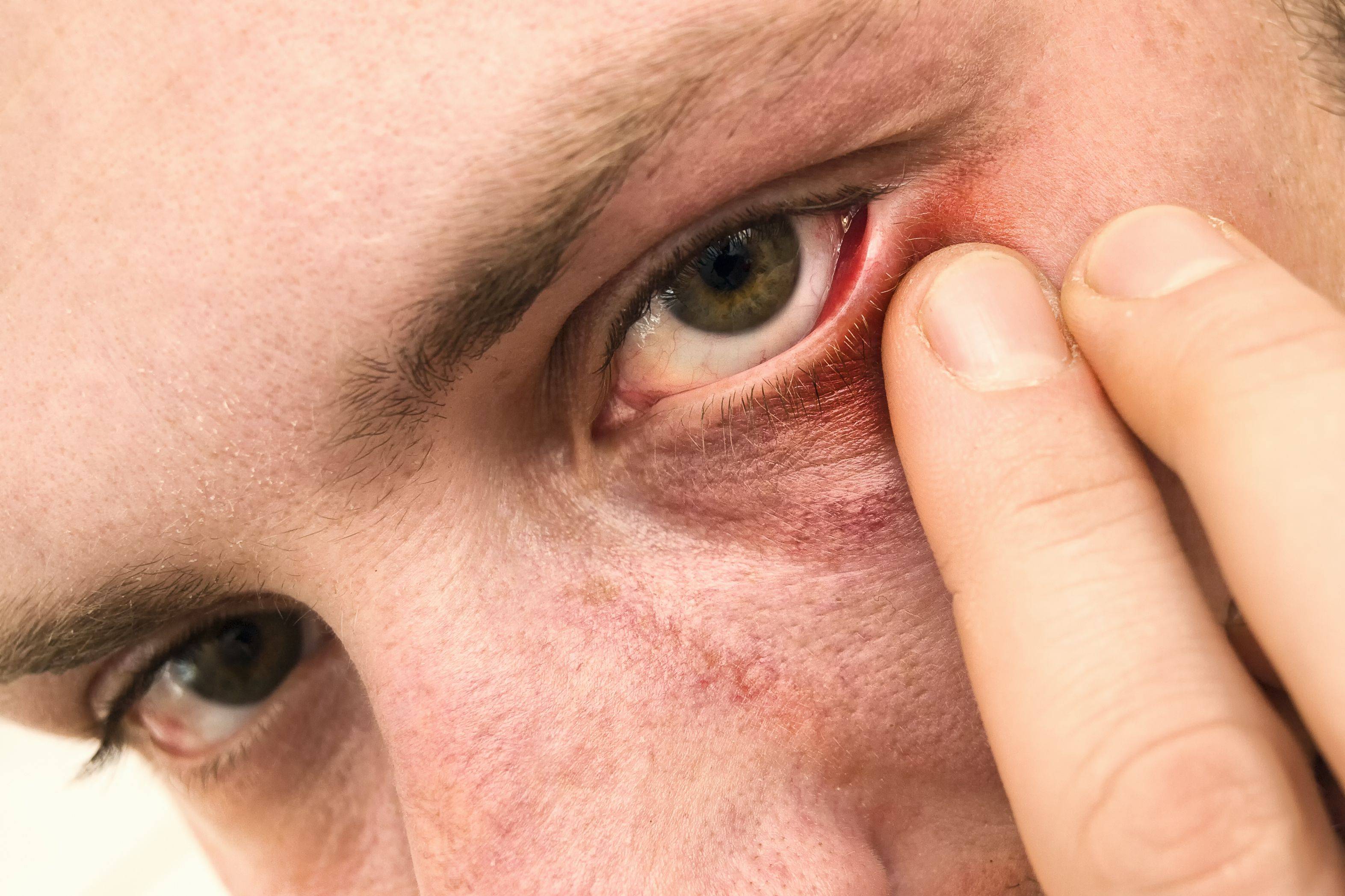 Болят глазные яблоки: возможные причины