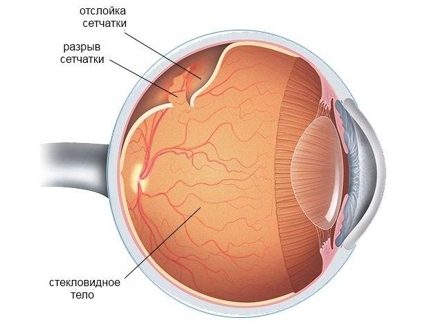 Отслойка стекловидного тела глаза лечение, ответы врачей, консультация