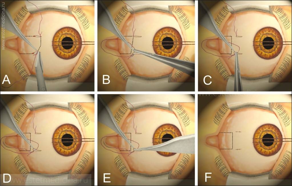 Лазерная коррекция зрения: всё, что нужно знать об операции