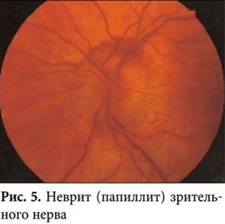 Как проявляется воспаление зрительного нерва: характерные симптомы, лечение и прогноз