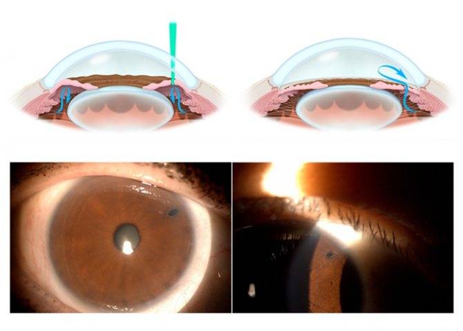 Важные рекомендации для пациентов после операции лазерной коагуляции сетчатки глаза: что можно и что нельзя делать, чтобы восстановление прошло хорошо