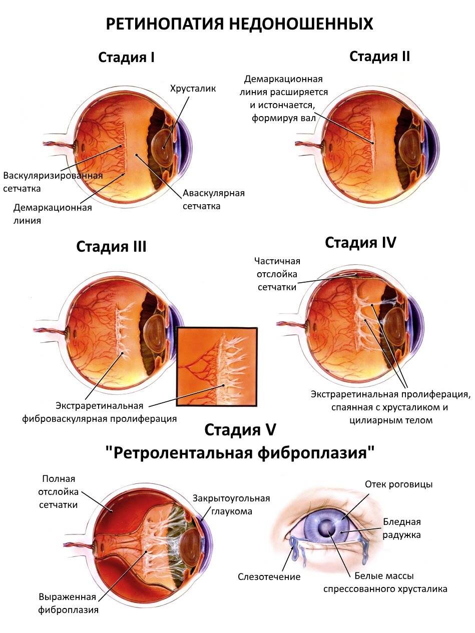 Ретинопатия недоношенных: симптомы и лечение - "здоровое око"