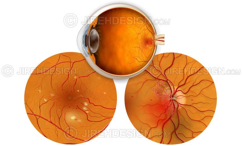 Диабетическая ретинопатия: что это и как лечить