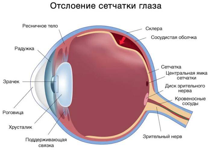 Ранние признаки и симптомы отслоения сетчатки глаза
