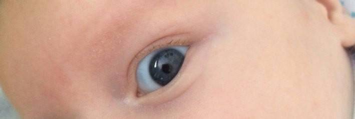 Серые уголки глаз у ребёнка