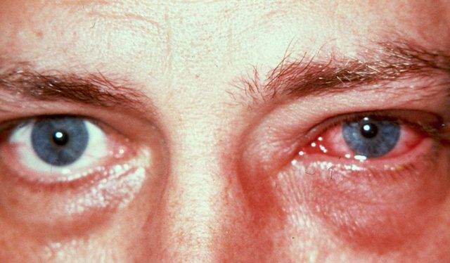Аллергия на линзы и раствор для линз