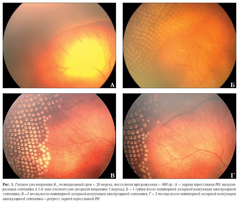 Отслоение сетчатки глаза - операция и восстановительный период