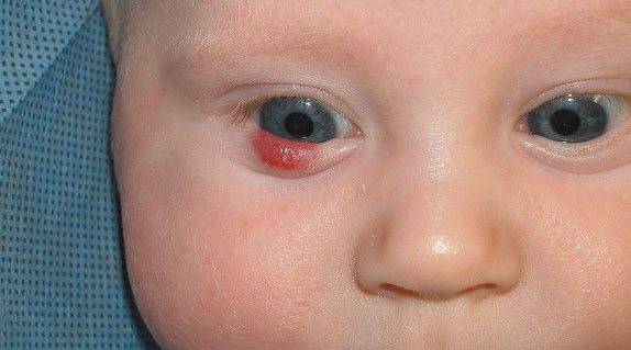 Гемангиома глаза у новорожденных детей и взрослых: список симптомов, причины возникновения, лечение, профилактика