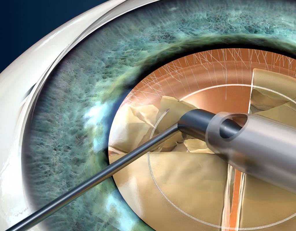 Как проводится операция катаракта?