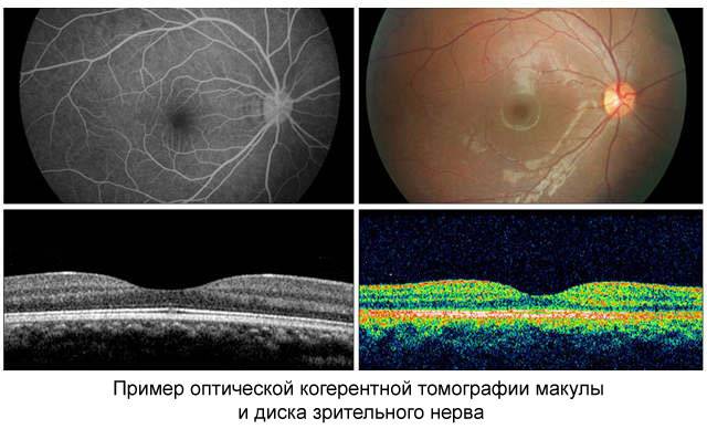 Диагностика томография глаза,что показывает кт глаза