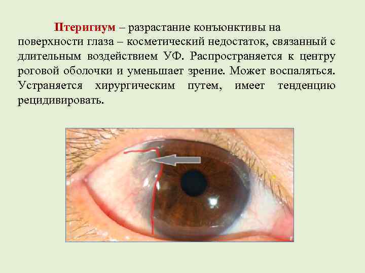 Нарушение с отрицательными последствиями – птеригиум глаза