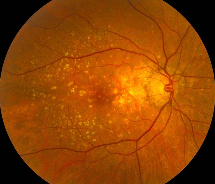 Дистрофия сетчатки глаза: как лечить - "здоровое око"