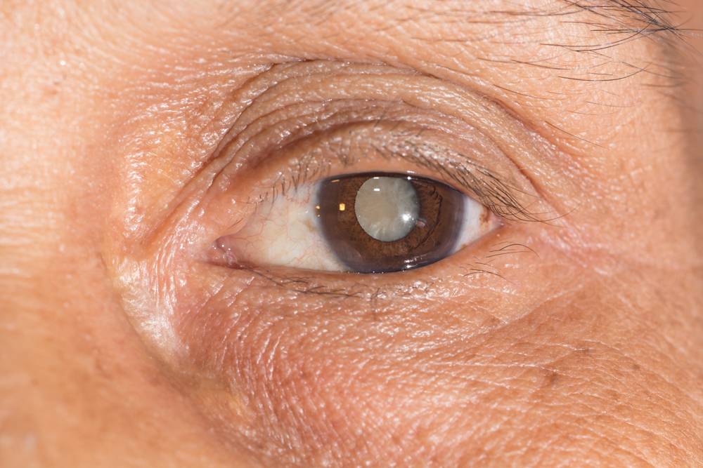Незрелая катаракта: лечение возрастной (старческой) патологии, причины, симптомы