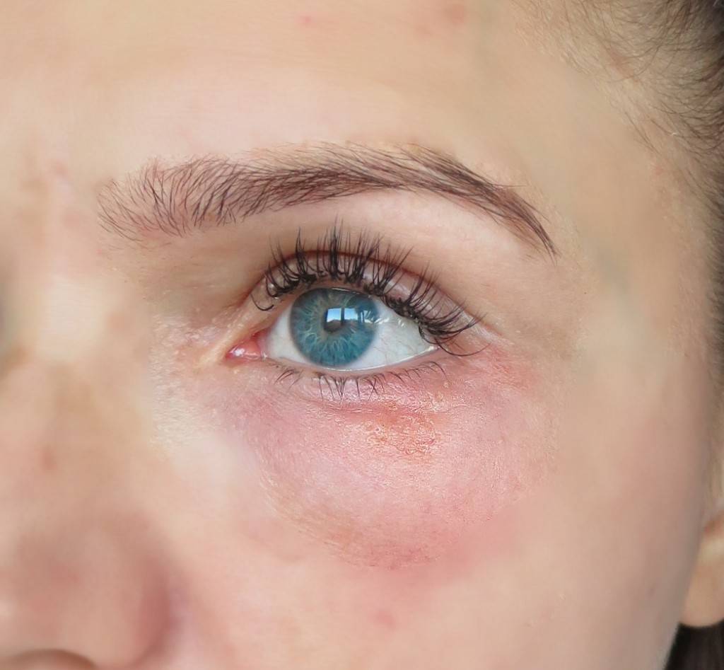 Красные точки под глазами: причины и лечение
