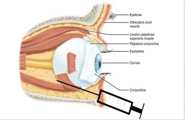 Инъекции в глазное яблоко. способы укалывания, используемые препараты