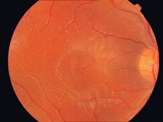 Ретиношизис: симптомы и лечение — как остановить болезнь и восстановить зрение