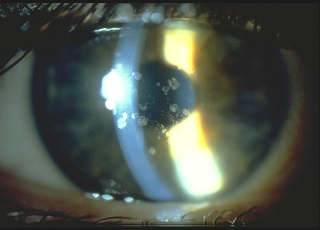 Дистрофия роговицы глаза: что это такое, лечение, виды дегенерации (эндотелиальная, лентовидная)