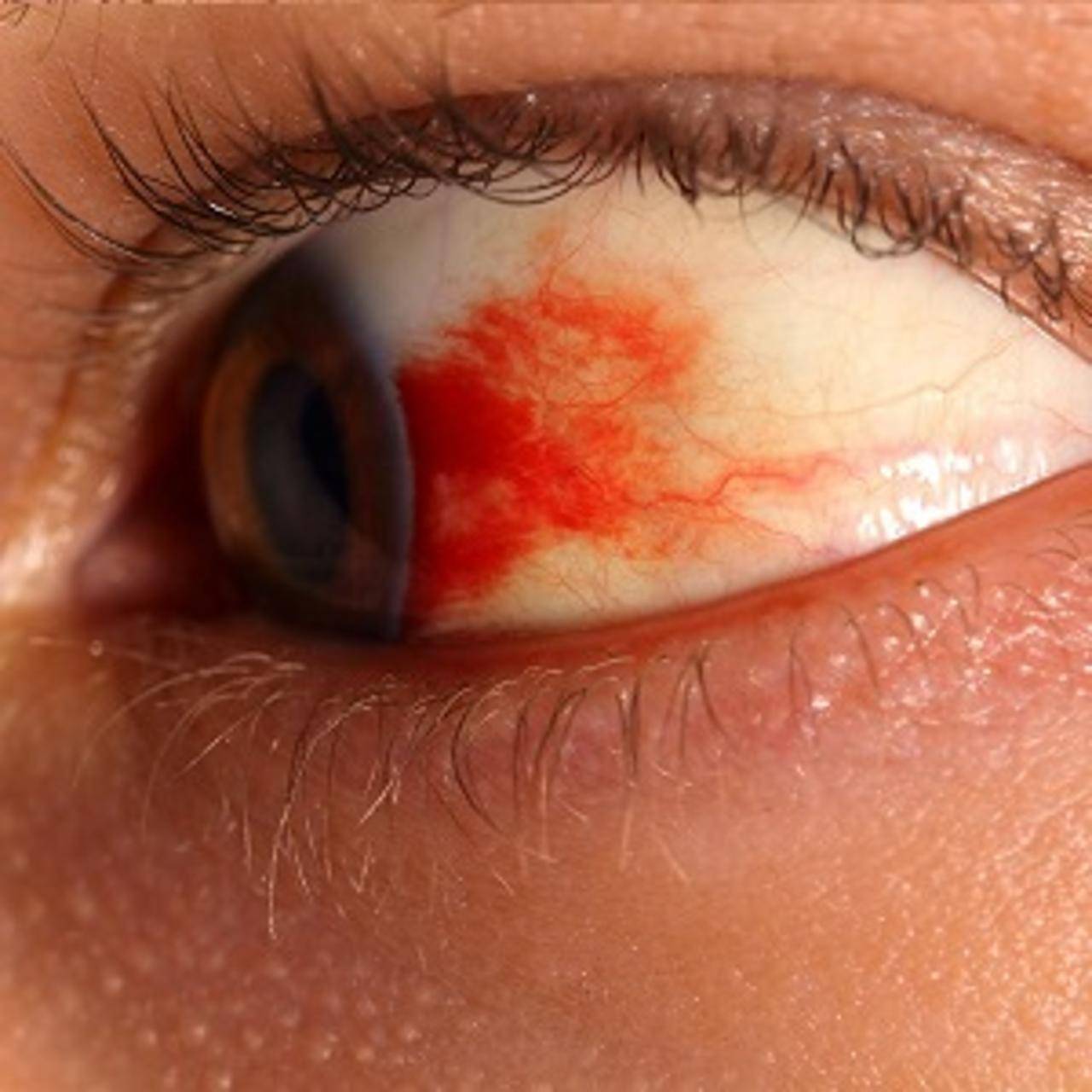 Кровоизлияние в склеру глаза - причины и лечение