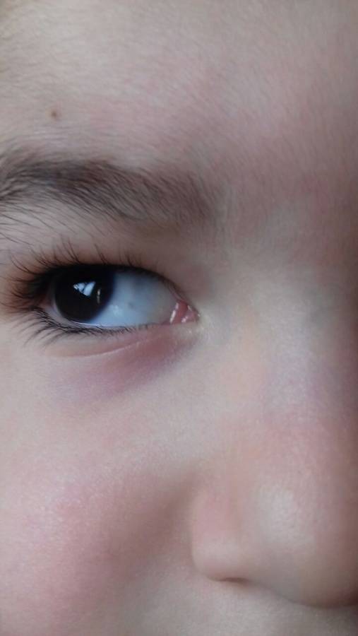 Почему у новорожденного серые белки глаз