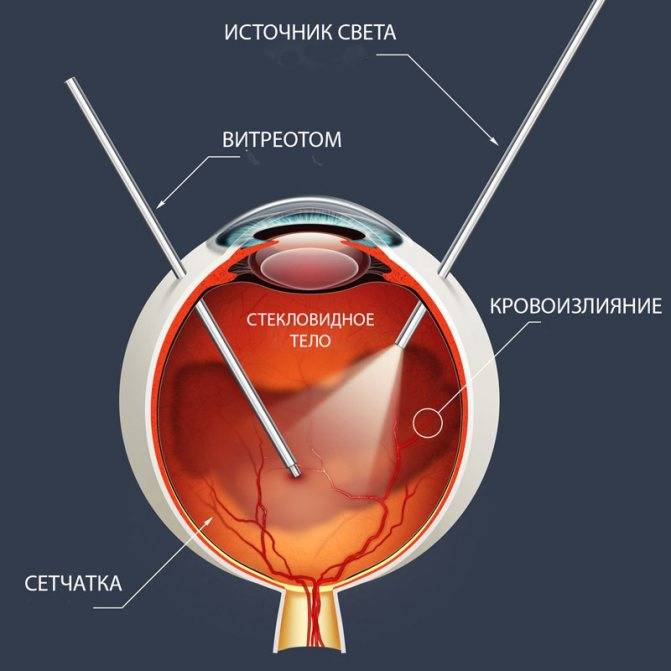 Гемофтальм: что это, частичный левого и правого глаза у взрослого, код по мкб 10 лечение, капли