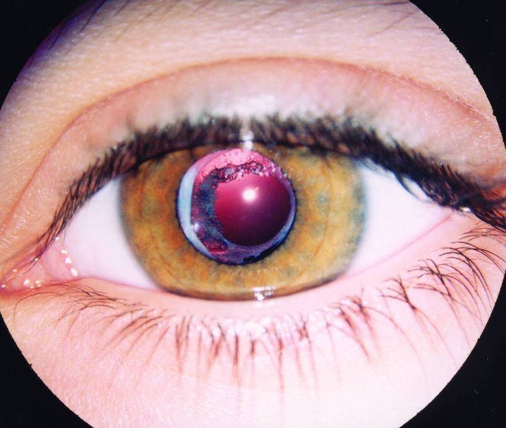 Афакия глаза: формы, причины, симптомы и лечение