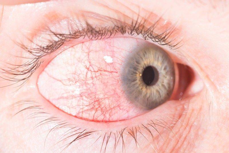 Эписклерит глаза: симптомы и лечение - "здоровое око"