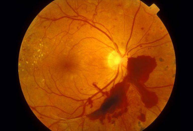 Офтальмоскопия глазного дна: описание, прямая и не прямая, методика проведения и расшифровка результатов