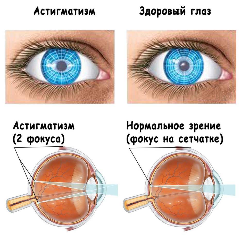 Все о линзах для глаз цветных не для зрения – польза и вред