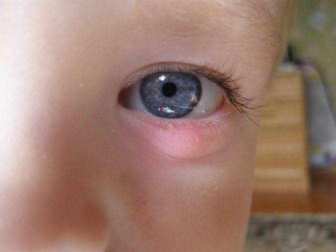 Воспаление глаза у ребенка: причины и лечение