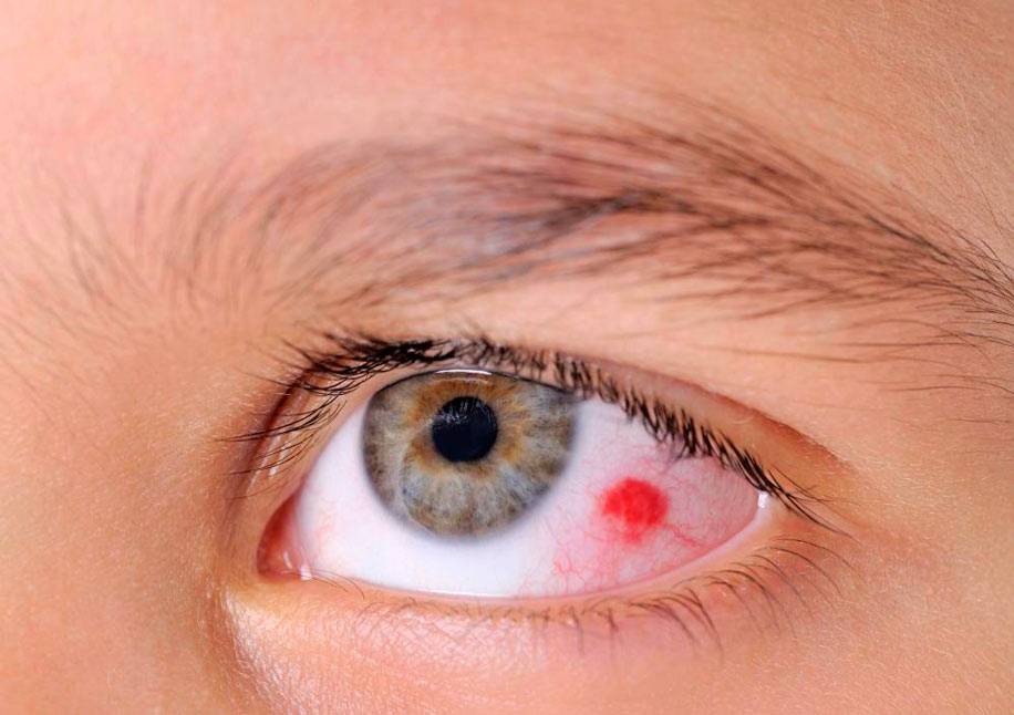 Кровоизлияние в глаз: причины и лечение, что делать