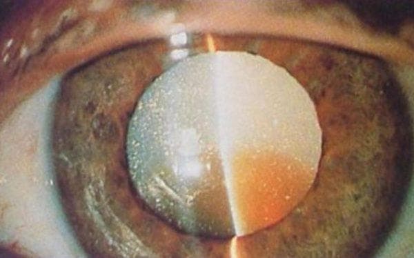 Старческая катаракта: причины, симптомы и лечение